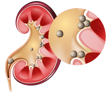 Kidney and Ureteral Stones Treatment