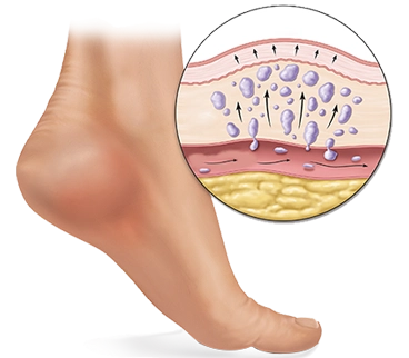 Swelling of Feet & Ankles Diagnosis